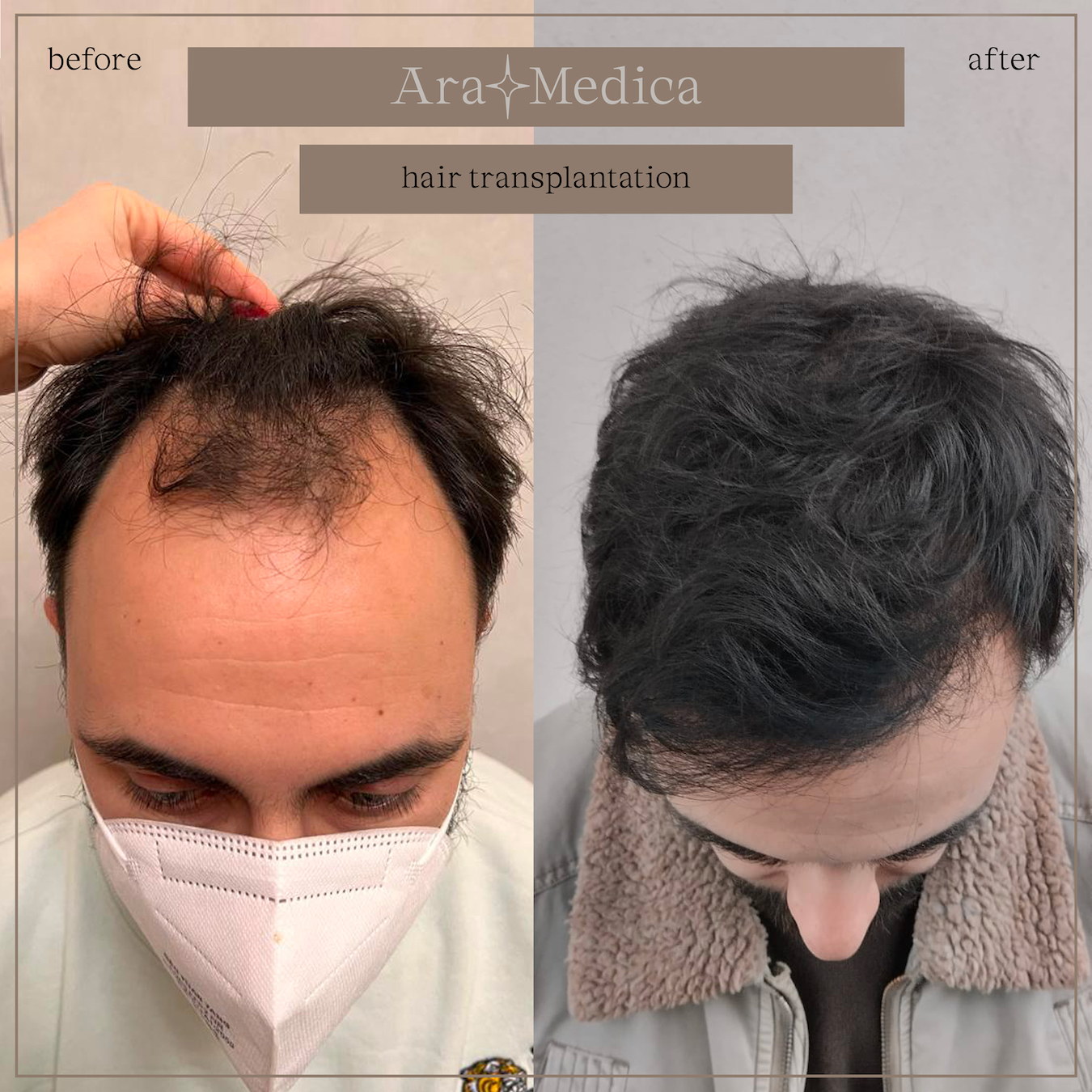 trasplante-de-pelo-3-l-m